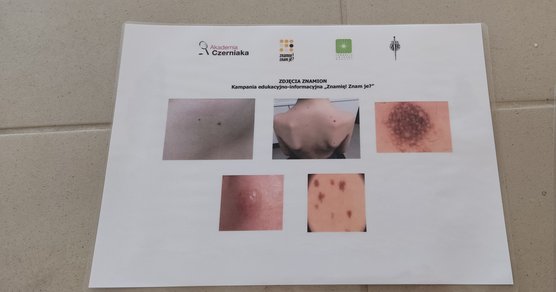 Znamię! Znam je?
